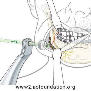 Transbuccal Device with Trocar_01