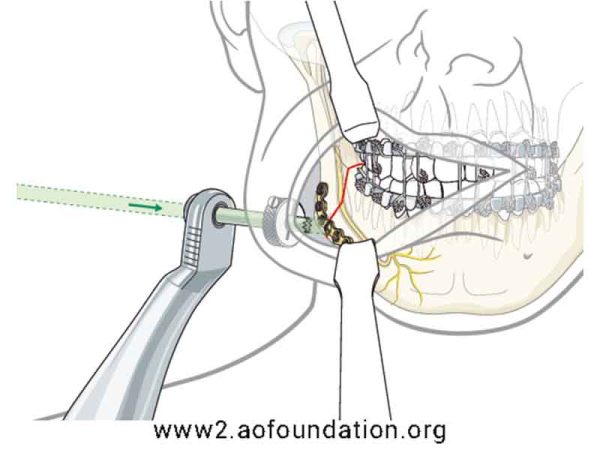 Transbuccal Device with Trocar_01